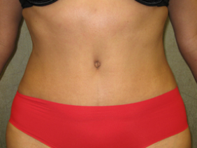 C.L.A.S.S ® Tummy Tuck after 926779