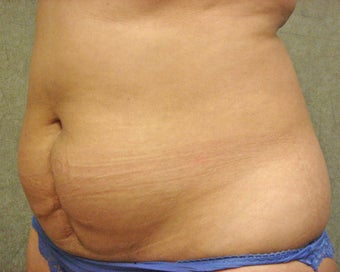 C.L.A.S.S ® Tummy Tuck 926779