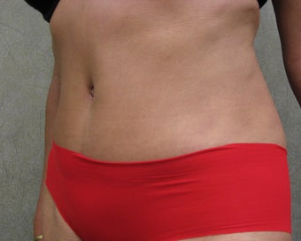 C.L.A.S.S ® Tummy Tuck 926779