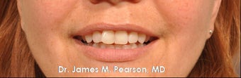 Lip Enhancement after 925991