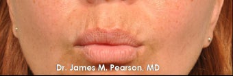 Lip Enhancement 925991