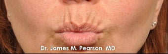 Lip Enhancement 925991