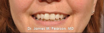 Lip Enhancement before 925991