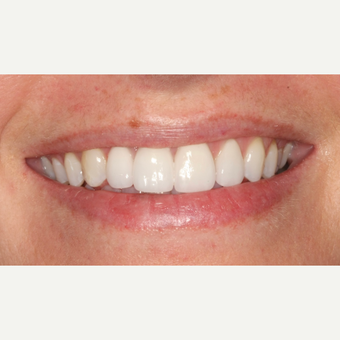 25-34 year old woman treated with Dental Implants after 3104328