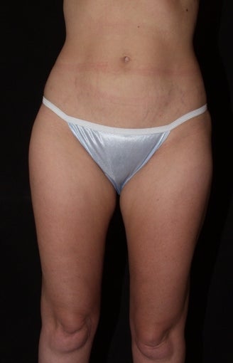 Vaser Liposuction of Lateral and Medial Thighs, Hips and Abdomen after 624865