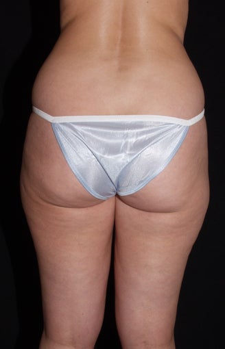 Vaser Liposuction of Lateral and Medial Thighs, Hips and Abdomen 624865