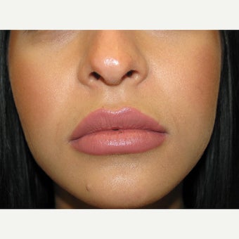 18-24 year old woman treated with Juvederm after 1540328
