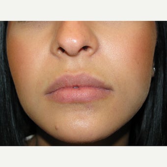 18-24 year old woman treated with Juvederm before 1540328