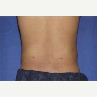 25-34 year old man treated with Laser Liposuction after 1958194