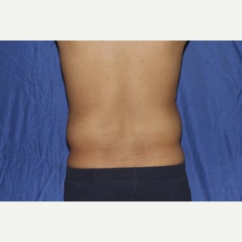 25-34 year old man treated with Laser Liposuction before 1958194