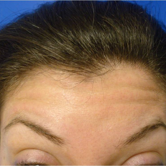 29 year old female treated with Botox the forehead before 3391157