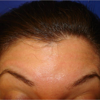 29 year old female treated with Botox the forehead after 3391157