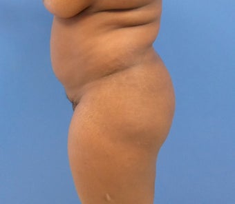 35 y.o. female – Lipo of abdomen, flanks, and back with fat transfer to buttocks – 1300cc per side before 3344842