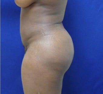35 y.o. female – Lipo of abdomen, flanks, and back with fat transfer to buttocks – 1300cc per side after 3344842