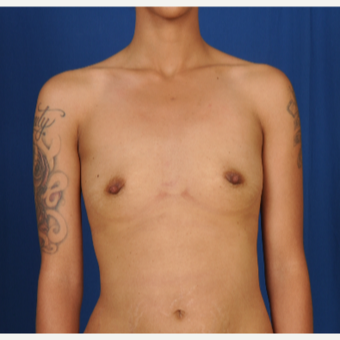 25-34 year old woman treated with Breast Augmentation before 3239963