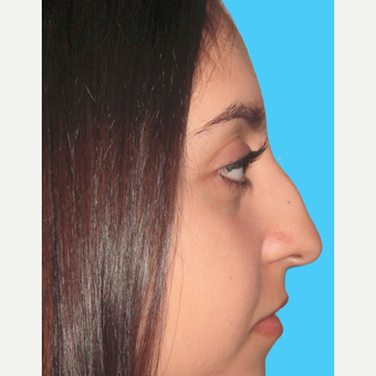 Rhinoplasty before 3814255