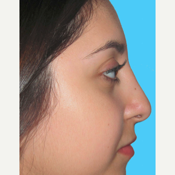 Rhinoplasty after 3814255