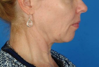 56 year old female interested in nonsurgical facial rejuvenation, Ulthera. before 1190884
