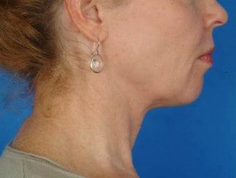 56 year old female interested in nonsurgical facial rejuvenation, Ulthera. after 1190884