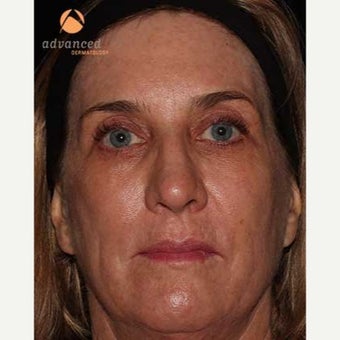 55-64 year old woman treated with CO2 Laser after 1757273