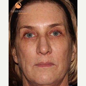 55-64 year old woman treated with CO2 Laser before 1757273