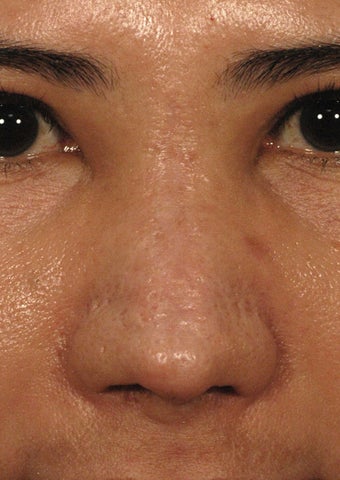 Fractional Laser Resurfacing for Burn Scar - Sciton Profractional after 1413048