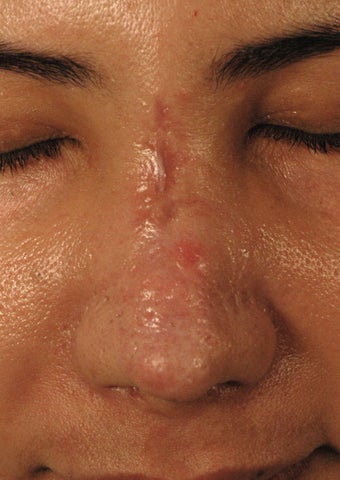 Fractional Laser Resurfacing for Burn Scar - Sciton Profractional before 1413048