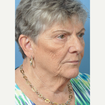 65-74 year old woman treated with Facelift before 3658150