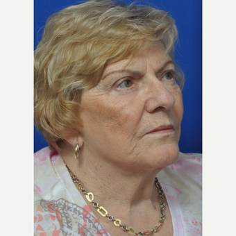 65-74 year old woman treated with Facelift after 3658150