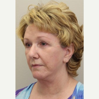 65-74 year old woman treated with Dermabrasion after 2168227