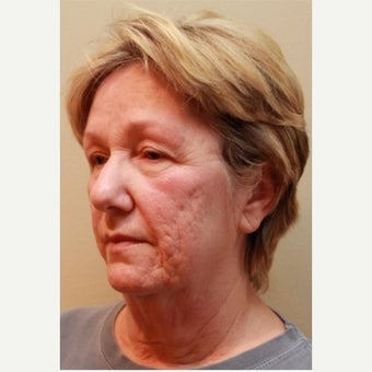65-74 year old woman treated with Dermabrasion before 2168227