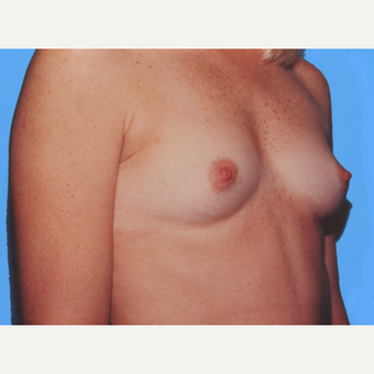 Breast Augmentation before 3732549