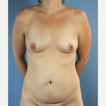 35-44 year old woman treated with Mommy Makeover before 3123497