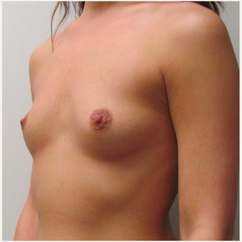 Anatomically -Shaped Gummy Bear Breast Implants for this 26 Year Old Woman before 2985421