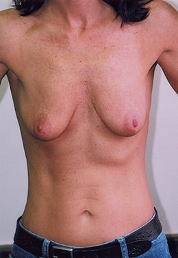 38 Year Old Female Breast Augmentation before 1355316