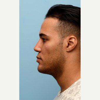 Full Face Non Surgical Treatment after 2725395