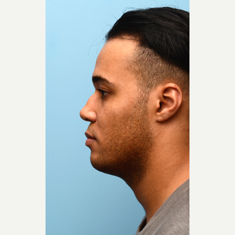 Full Face Non Surgical Treatment before 2725395