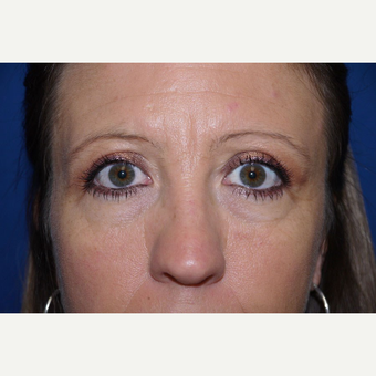 Eyelid Surgery after 3744052