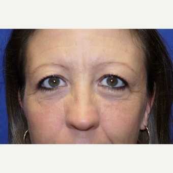 Eyelid Surgery before 3744052