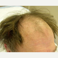 65 year old man treated with FUE Hair Transplant before 3815496