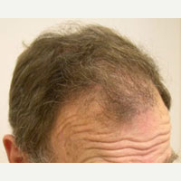 65 year old man treated with FUE Hair Transplant after 3815496