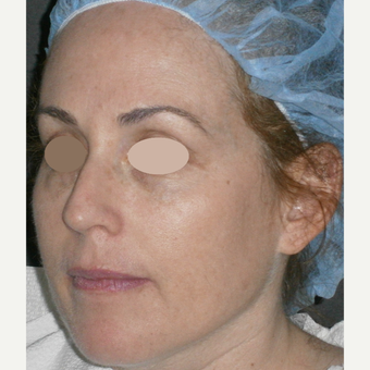 45-54 year old woman treated with IPL after 3089329