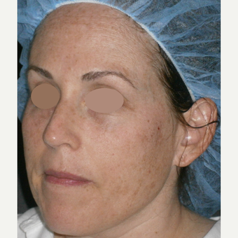 45-54 year old woman treated with IPL before 3089329