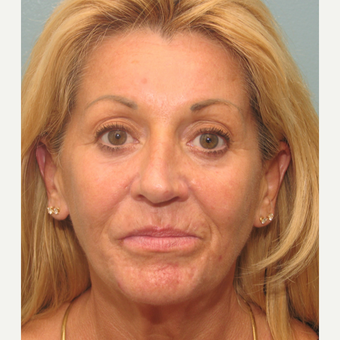 55-64 year old man treated with Injectable Fillers, Bellafill, Ultherapy before 3243164