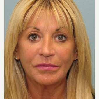 55-64 year old man treated with Injectable Fillers, Bellafill, Ultherapy after 3243164