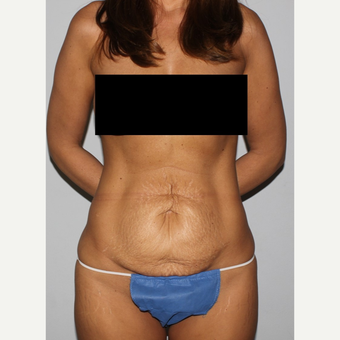 35-44 year old fit woman treated with Tummy Tuck before 3500942