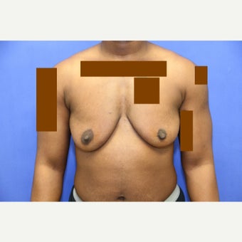 29 year old transgender man treated with FTM Chest Masculinization Surgery before 2096577