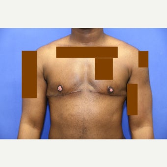 29 year old transgender man treated with FTM Chest Masculinization Surgery after 2096577