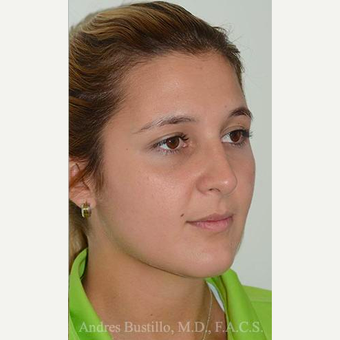 23 year old woman treated with Rhinoplasty after 3460880