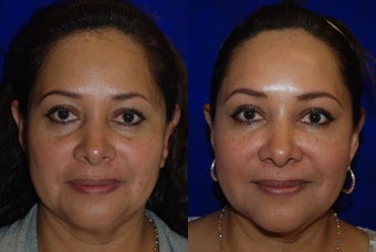 Liquid Facelift before 1376650